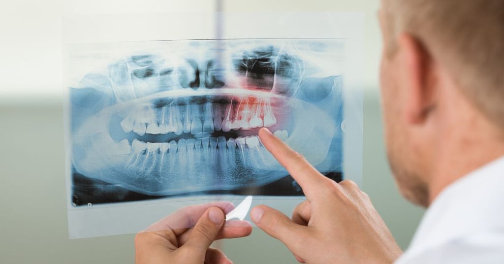 Meerdere tandproblemen tegelijk vraagt operatie
