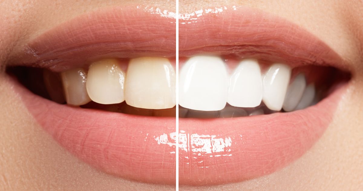 Tanden bleken voor en na