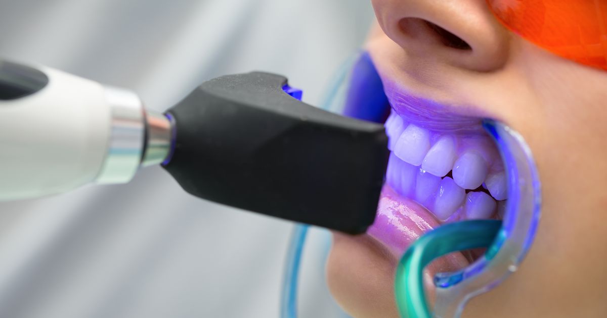 Vermijd gevoelige tanden en laat je tanden bleken bij de tandarts