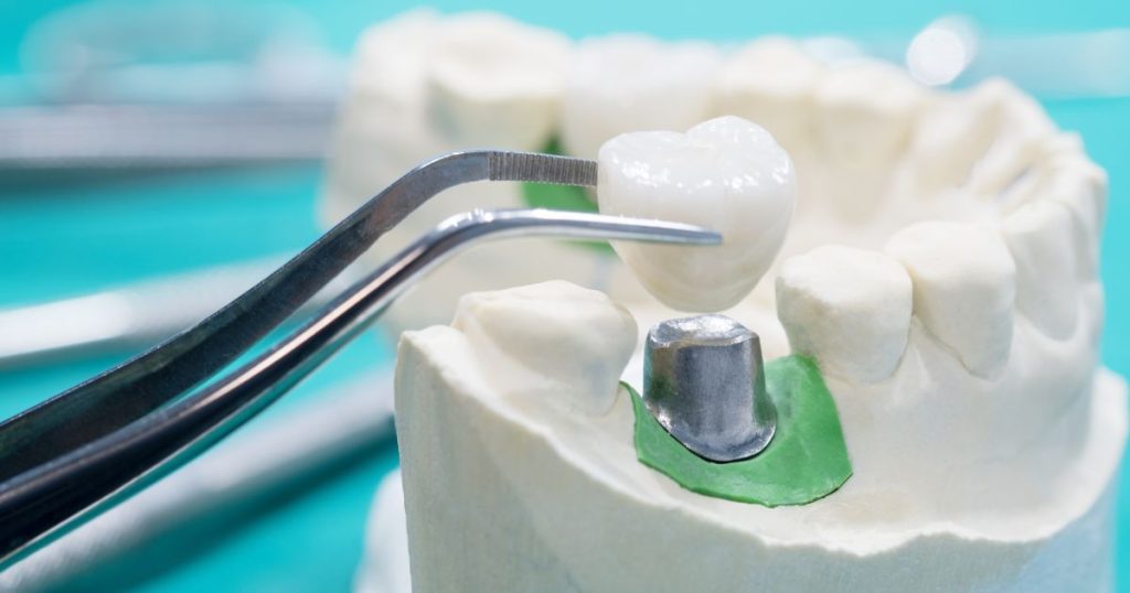 Implantaat met tandkroon